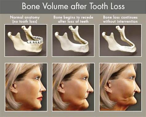 Surgery For Bone Loss In Gums at Diane Ashton blog