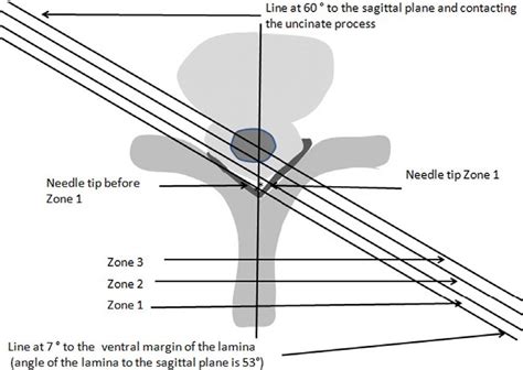 Image result for Contralateral Oblique View
