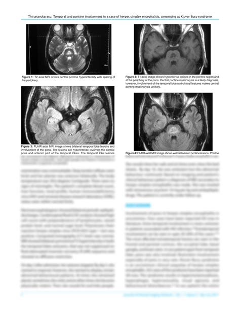 SOLUTION: Temporal and pontine involvement in a case of herpes simplex encephalitis presenting ...