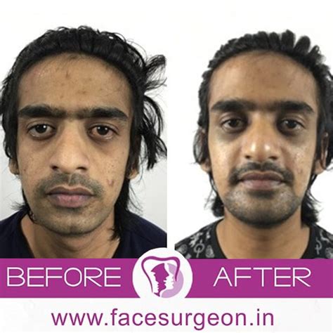 All That You Need To Know About Beard Hair Transplant In India ...