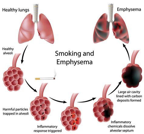 Emphysema Life Expectancy 的图像结果
