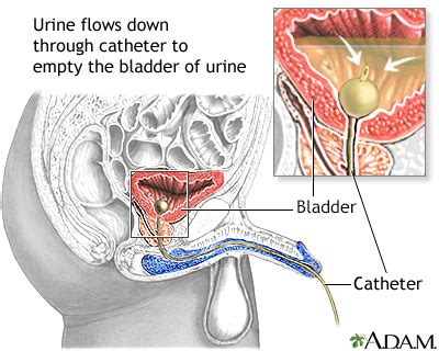 Image result for Bladder Explode