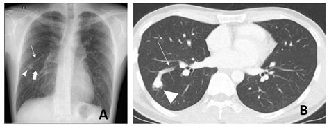 The Role of Interventional Radiology in the Diagnosis and Treatment of Pulmonary Arteriovenous ...