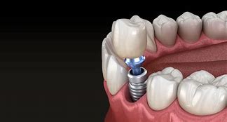 Image result for implant