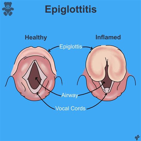 Tripoding Epiglottitis at Jacqueline Sadler blog