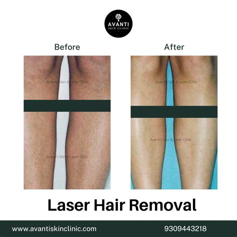 Laser Hair Removal: What to Expect Before & After Treatment