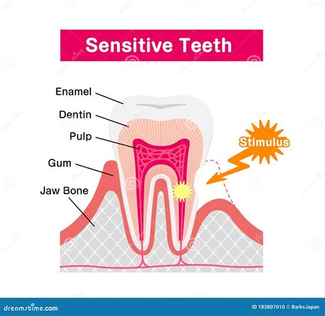 Cause and Mechanism of Sensitive Teeth Illustration Stock Vector - Illustration of healthy ...