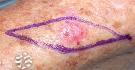 Image result for Mutilation Excision