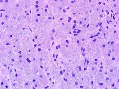 Pathology Outlines - Granular cell tumor