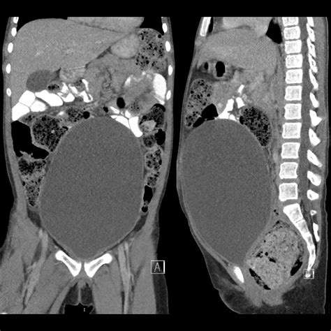 School ager with progressive abdominal distension and abdominal pain over the last month and new ...