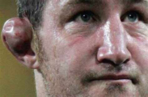 Bildergebnis für worst cauliflower ear ever