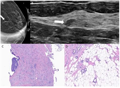 Active Surveillance of Atypical Ductal Hyperplasia of the Breast - Clinical Breast Cancer