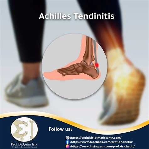 Achilles Tendon Pain Symptoms Flash Sales | www.repc.com