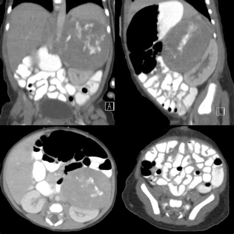 Newborn with a left abdominal mass and palpable subcutaneous nodules on the right chest wall ...
