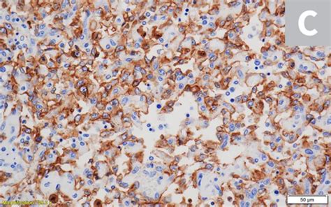 Image result for Hemangiosarcoma