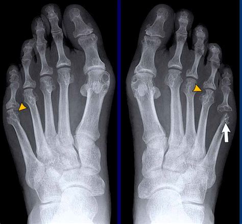 X Ray Of Foot