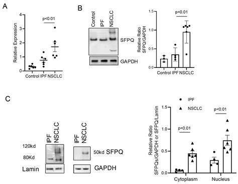 SFPQ and Its Isoform as Potential Biomarker for Non-Small-Cell Lung Cancer