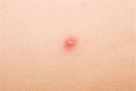 Different Types of Pimples and How to Tackle Them