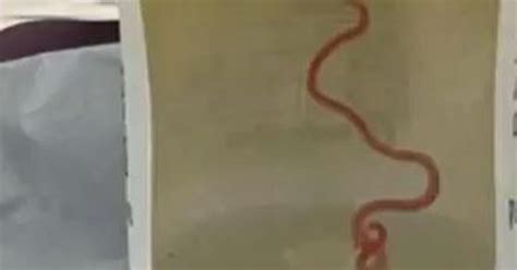 Neurosurgeon probing patient’s mystery symptoms plucks worm from woman ...