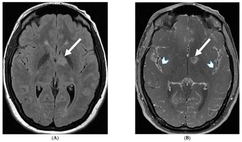 Pediatric Meningeal Diseases: What Radiologists Need to Know