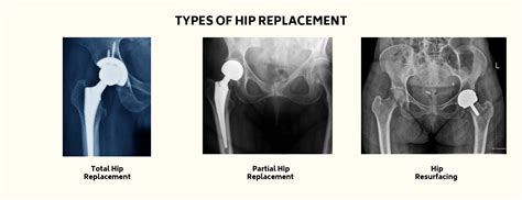 Hip Replacement Surgery in Ahmedabad | Dr. Ateet Sharma