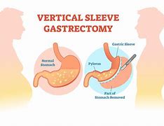 Gastrectomy 的图像结果