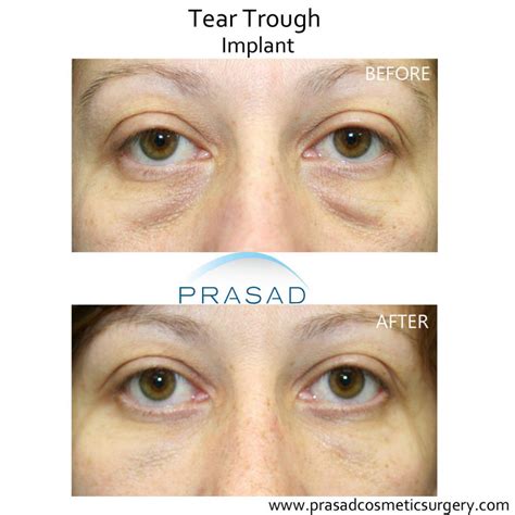 Hollow Eyes Before After 1 Effective PRP/ PRF Under Eyes Treatment For