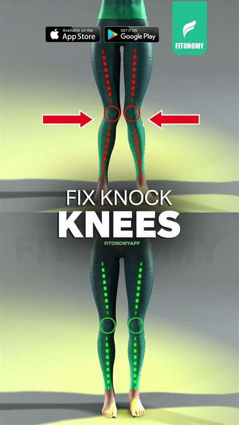 How To Fix Knock Knees