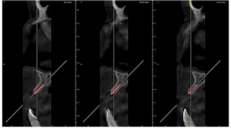 FEM Analysis of Individualized Polymeric 3D Printed Guide for ...