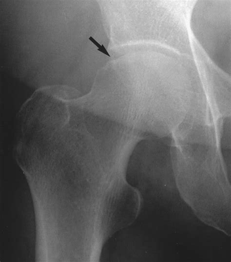 Subchondral Insufficiency Fracture of the Femoral Head Resulting in Rapid Destruction of the Hip ...