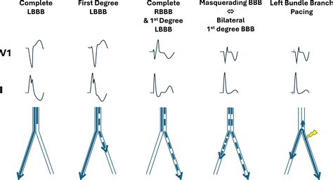 First- and second-degree left bundle branch block and masquerading ...