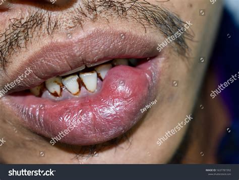 Mucous Cyst Mucocele Lower Lip Southeast: стоковая фотография (редактировать), 1637781592