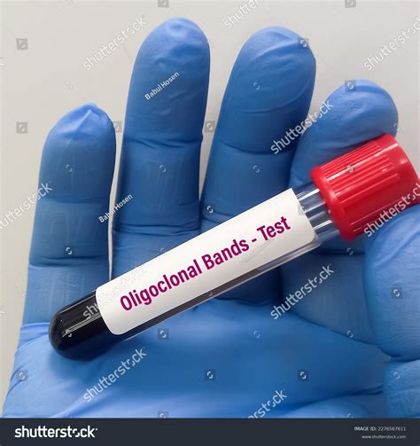 2 Oligoclonal Band Analysis Images, Stock Photos & Vectors | Shutterstock
