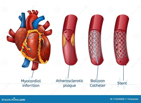 Myocardial Infarction. 3d Realostic Stent in Heart Stock Vector ...