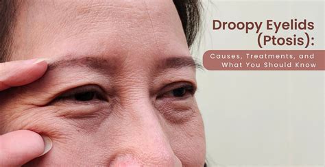 Droopy Eyelid Ptosis Causes Risk Factors And Treatment What Causes A