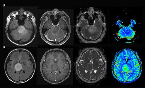 The 2021 WHO Classification for Gliomas and Implications on Imaging Diagnosis: Part 2—Summary of ...
