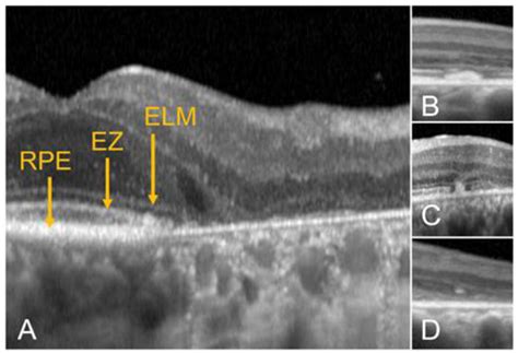 Optical Coherence Tomography in Inherited Macular Dystrophies: A Review