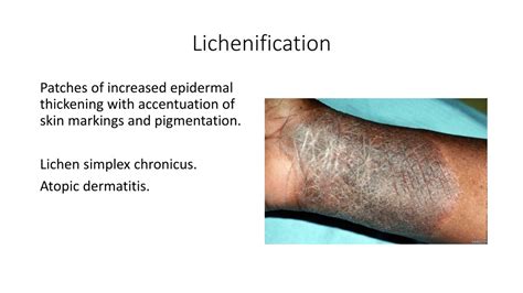 PPT - Language of Dermatology PowerPoint Presentation, free download - ID:248743