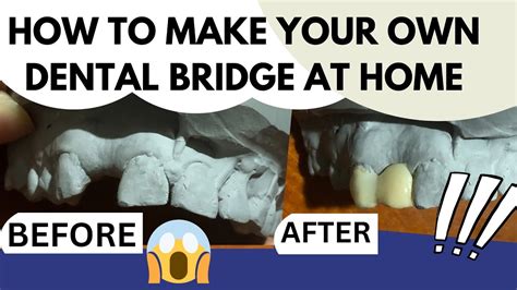 Homemade Dental Bridge 的图像结果