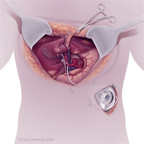 Hepatic Artery Infusion Pump