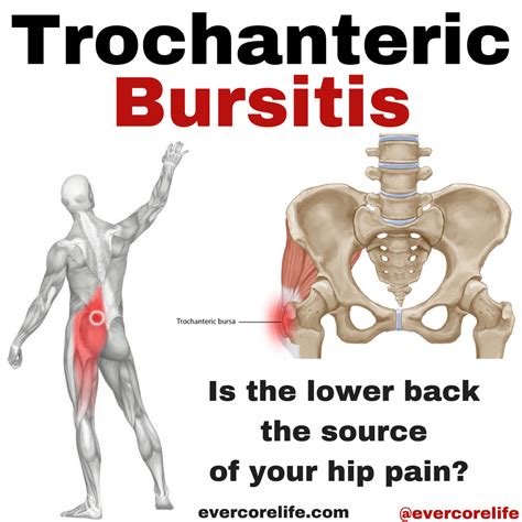 Trochanteric Bursitis Treatments