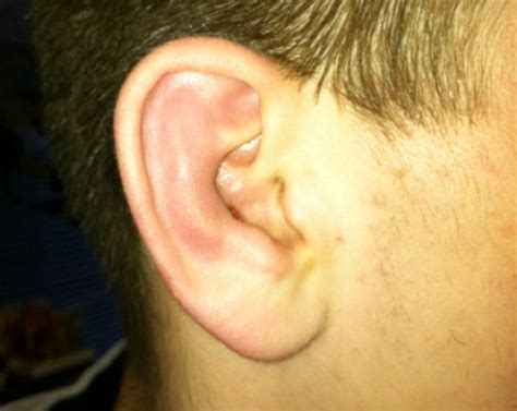 Bildergebnis für cauliflower ear before and after