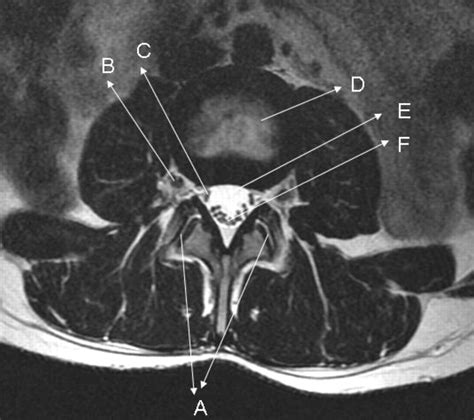 Lumbar Spine Mri Axial