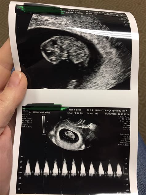 8 Weeks Pregnant Sonogram