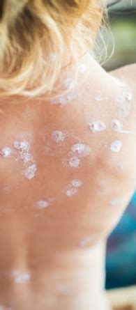 Penvir - Famciclovir, Antiviral Medicine for Shingles and Genital Herpes