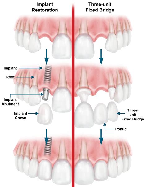 Dental Bridge - Procedure, Dental Bridge Vs Dental Implant