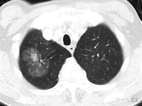 判断肺混合磨玻璃结节不是癌，这一点很重要