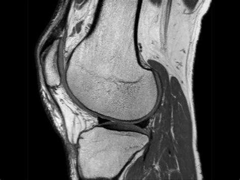 Comprehensive 3D knee imaging with MSK VIEW | Philips MR Body Map