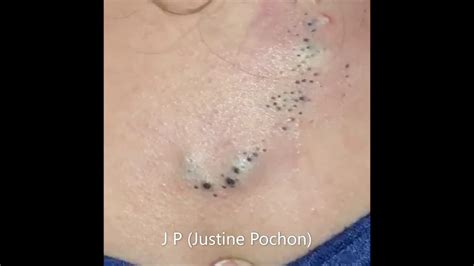 Image result for Exploding Back Zits
