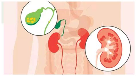 Kidney Stones vs Gallbladder Stones: What is the difference and which ...